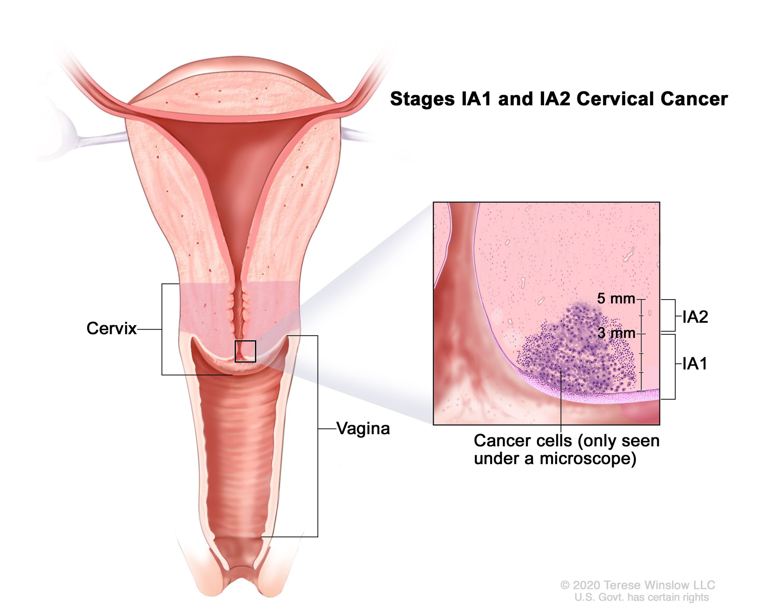 Лечение рака шейки матки в клинике OncoCareClinic