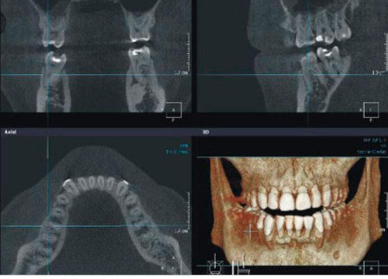 Томография зубов: как это работает и почему она важна для вашего здоровья